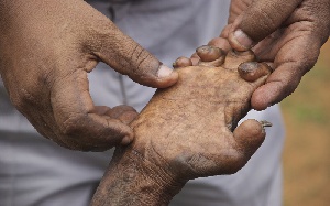 Ankaful Leprosy Hand