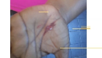An injury from one of the alleged attacks on the wife