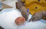 Kumasi doctors remove 880-gram bladder stone from 49-year-old man