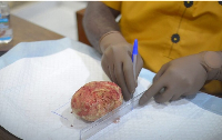 Photo of the 880-gram bladder  retrieved after surgery