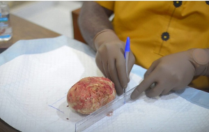 Photo of the 880-gram bladder  retrieved after surgery