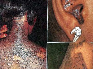 Skin disorders as a result of bleaching.