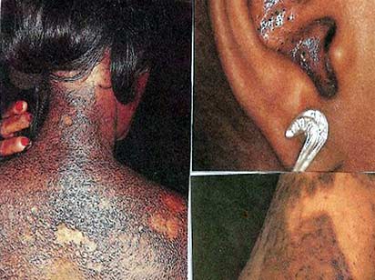Skin disorders as a result of bleaching.