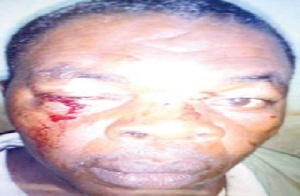 Rev Bismarck Mensah with bruises under his right eye