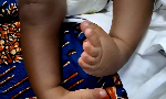 Photo of child with clubfoot