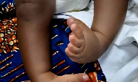 Photo of child with clubfoot