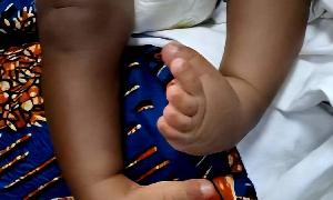 Photo of child with clubfoot