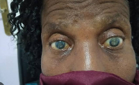 File photo of a cataract patient.