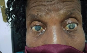 Cataracts File Photo