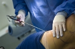 File photo of a patient undergoing liposuction procedure