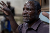 ean Kakuru Biyambo, from the Muja internally displaced persons camp, is seen at the Goma Gen. Hosp.