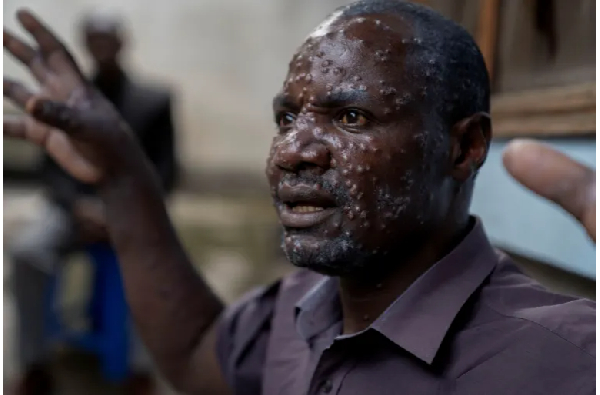 ean Kakuru Biyambo, from the Muja internally displaced persons camp, is seen at the Goma Gen. Hosp.