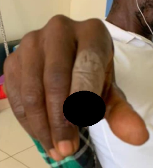 The victim showing his finger that has been bitten off