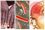 2025 in Review: Major disease outbreaks reported across Ghana
