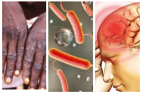 Mpox, cholera and meningitis outbreaks were recorded in 2025