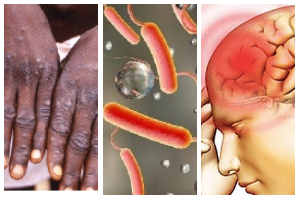 Mpox, cholera and meningitis outbreaks were recorded in 2025
