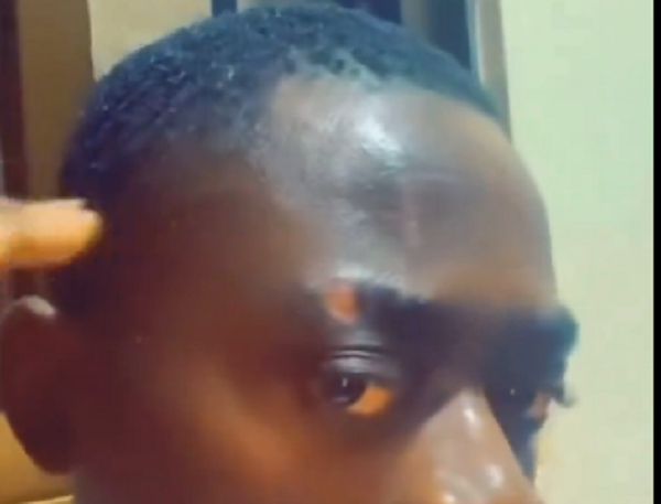 LilWin displaying a scar on his eyebrow