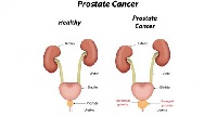 Subsidizing prostate cancer treatment would help save many lives