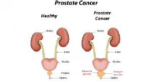 Subsidizing prostate cancer treatment would help save many lives